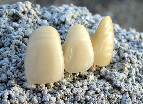 Porcelain fused to metal tooth